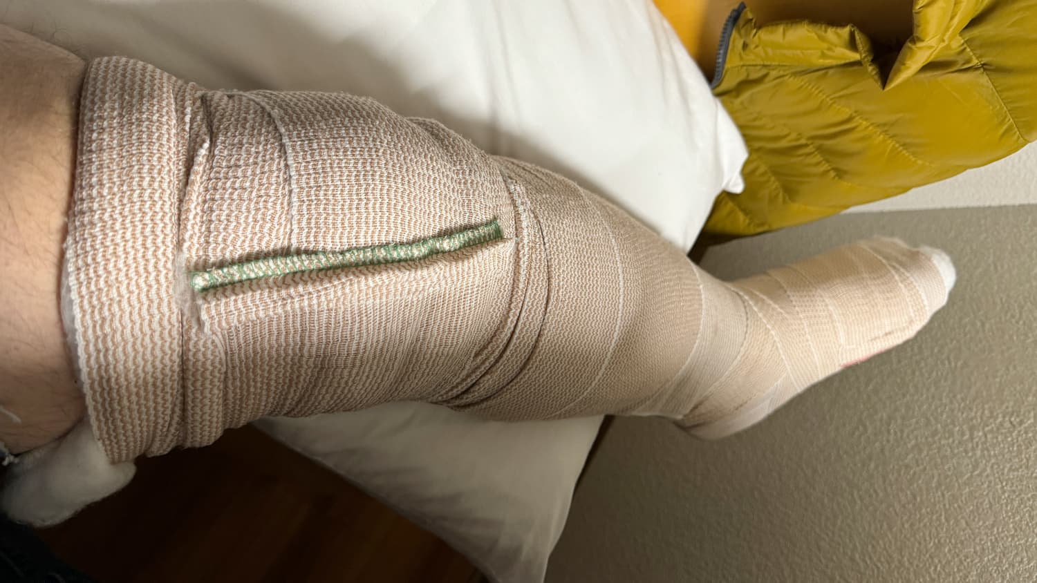 Ein Bein in einem Verband
