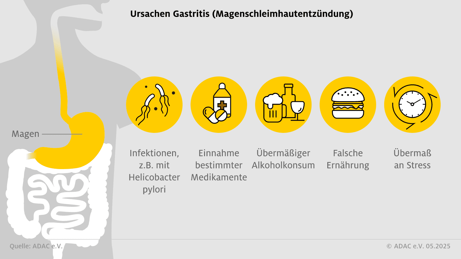 Infografik zu Nierensteinen