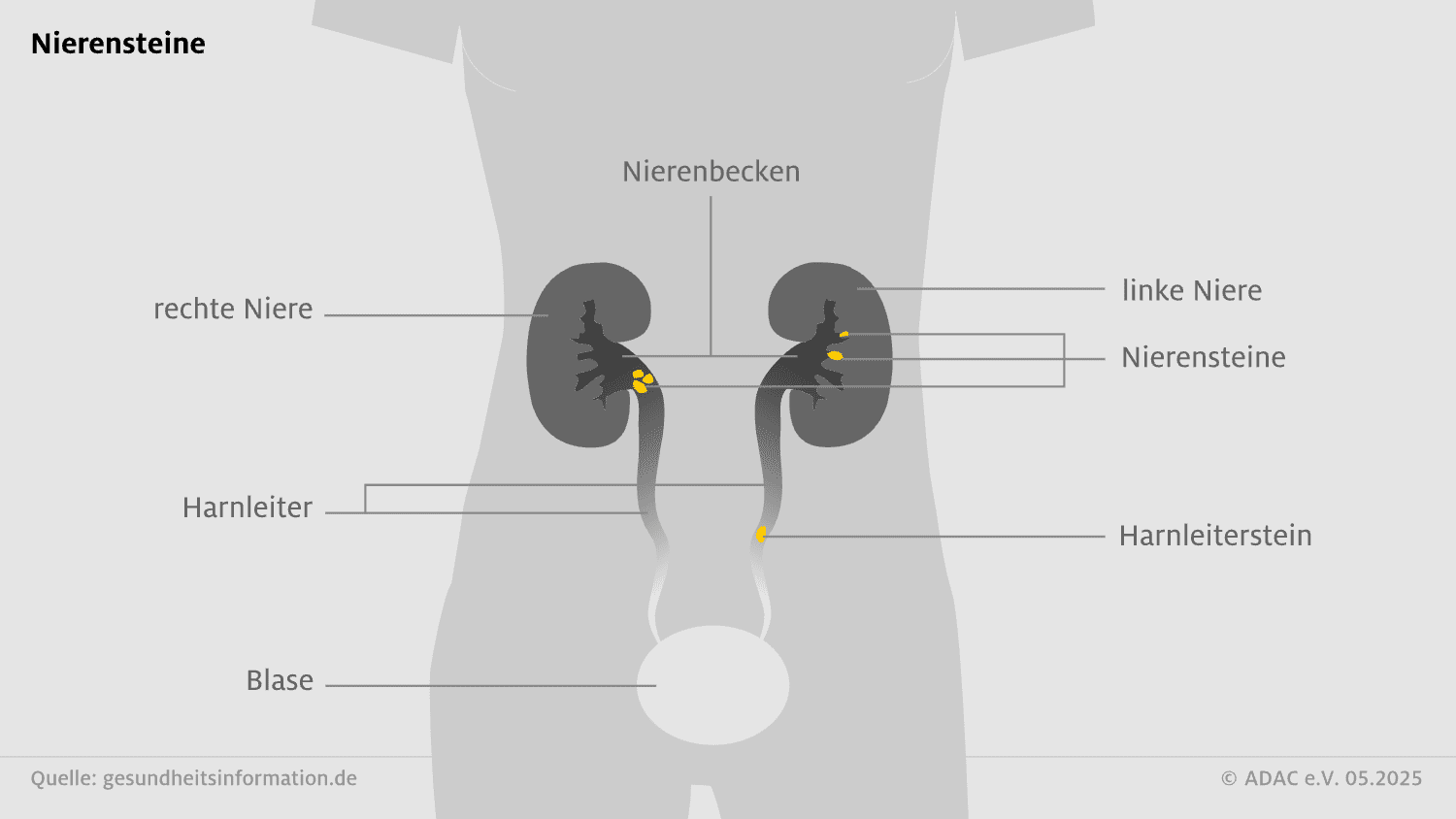 Infografik zu Nierensteinen