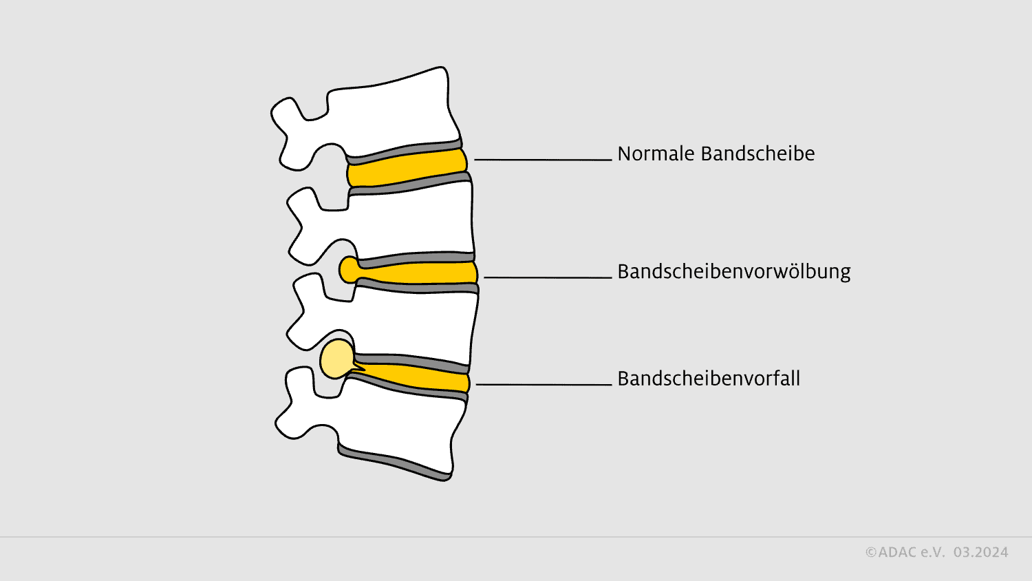 Bandscheibenvorfälle-Vorwölbung und Vorfall der Bandscheibe