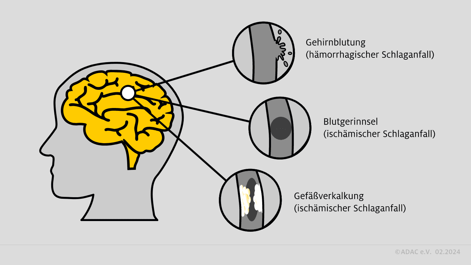 Ischämischer Schlaganfall-Übersicht der Schlaganfall-Arten
