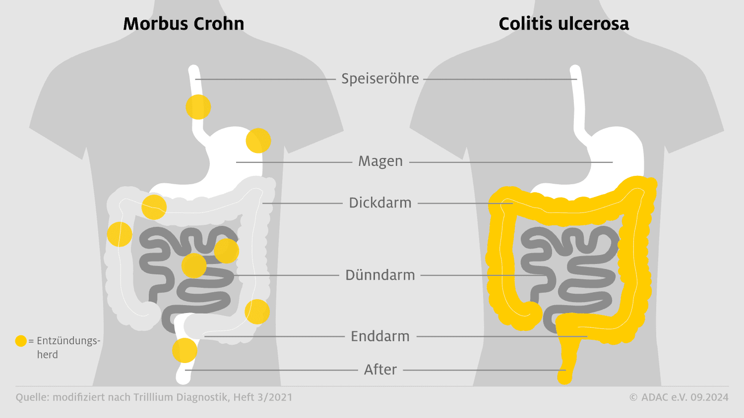 Morbus Crohn vs. Colitis ulcerosa Entzündungsherde im Vergleich