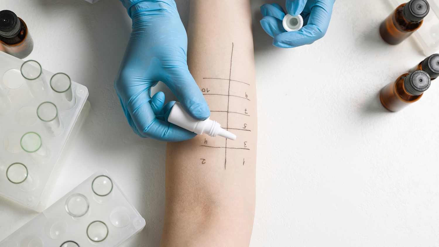 Medizinisches Personal führt einen Pricktest durch, um Allergien festzustellen