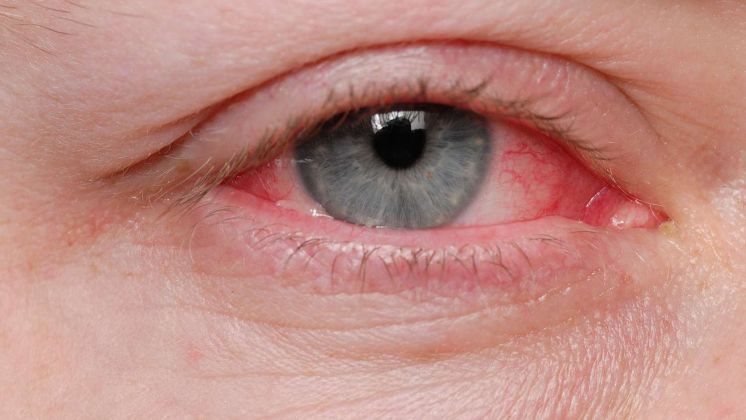 Ein rotes Auge durch Bildndehautentzündung