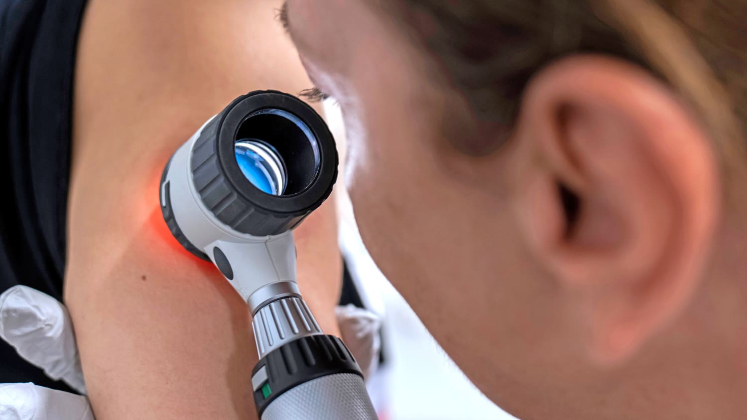 Der Dermatologe untersucht Muttermale auf der Haut des Patienten mit einem Dermatoskop.