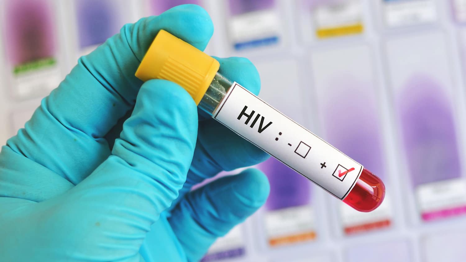 Ein laborant hält ein röhrchen mit Blut positiv auf HIV getestet in der behandschuhten Hand