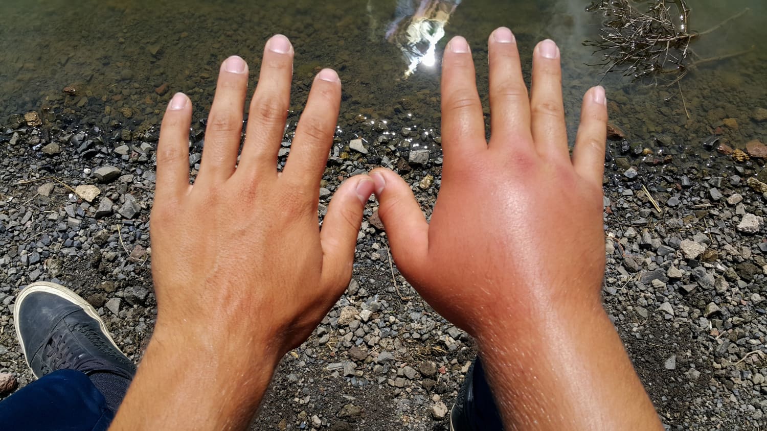 Zwei Männerhände nebeneinander. Die rechte Hand ist deutlich geschwollen