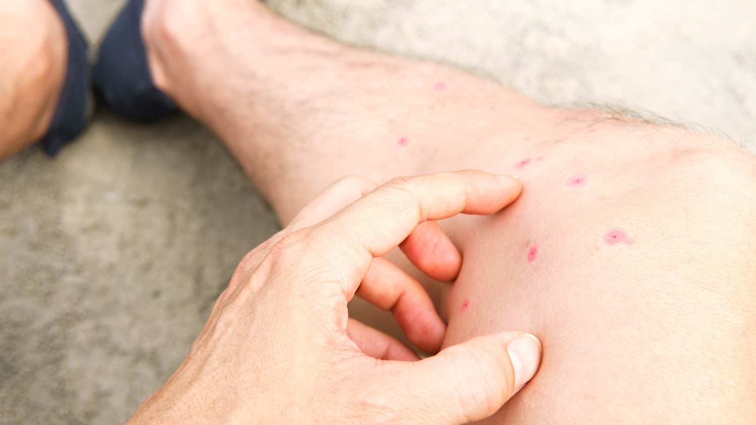 Beine mit sichtbaren Stichen der Sandmücke