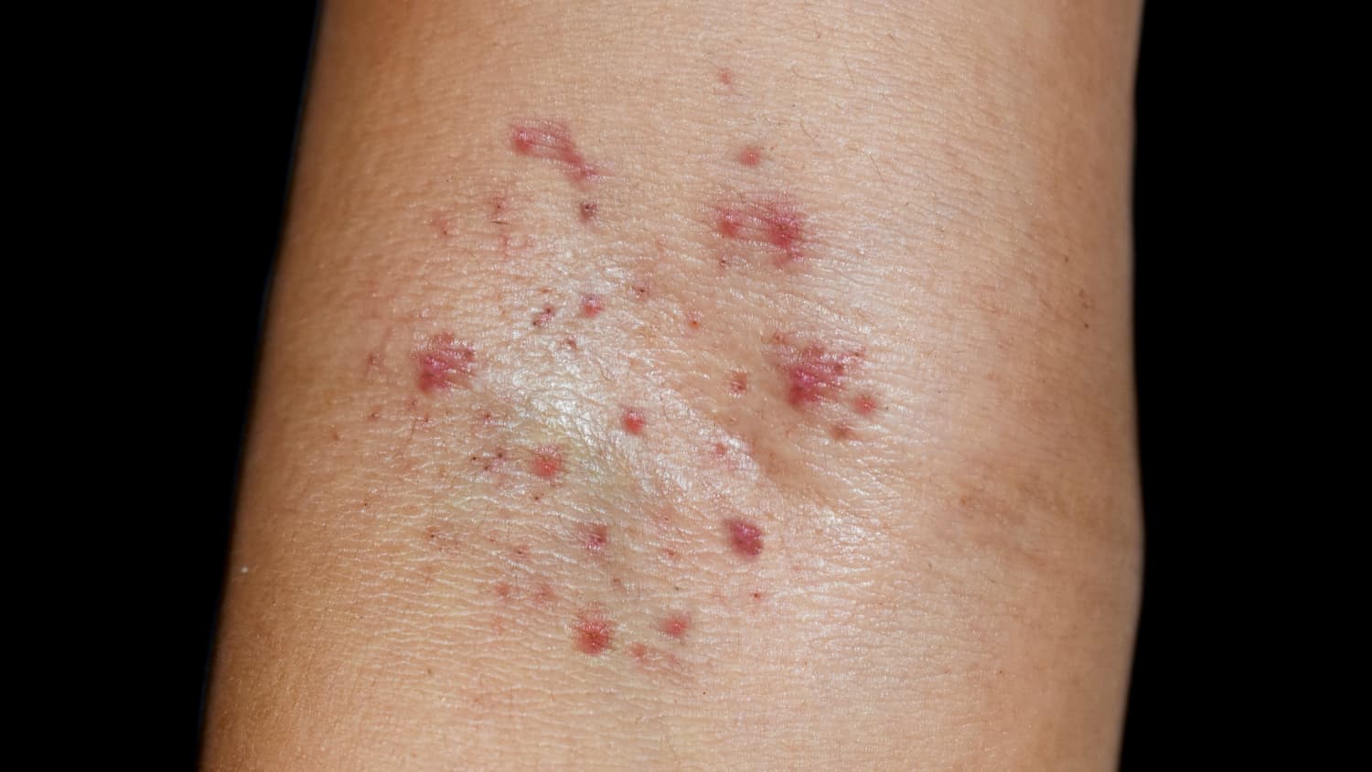 Hautausschlag aufgrund einer Sepsis an der Arminnenseite
