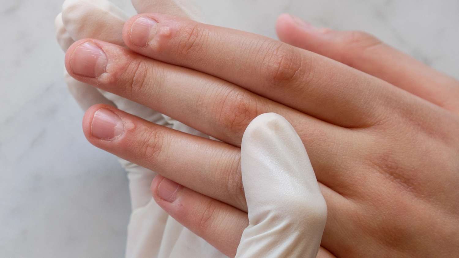 Viele Warzen an den Fingern einer jungen Frau