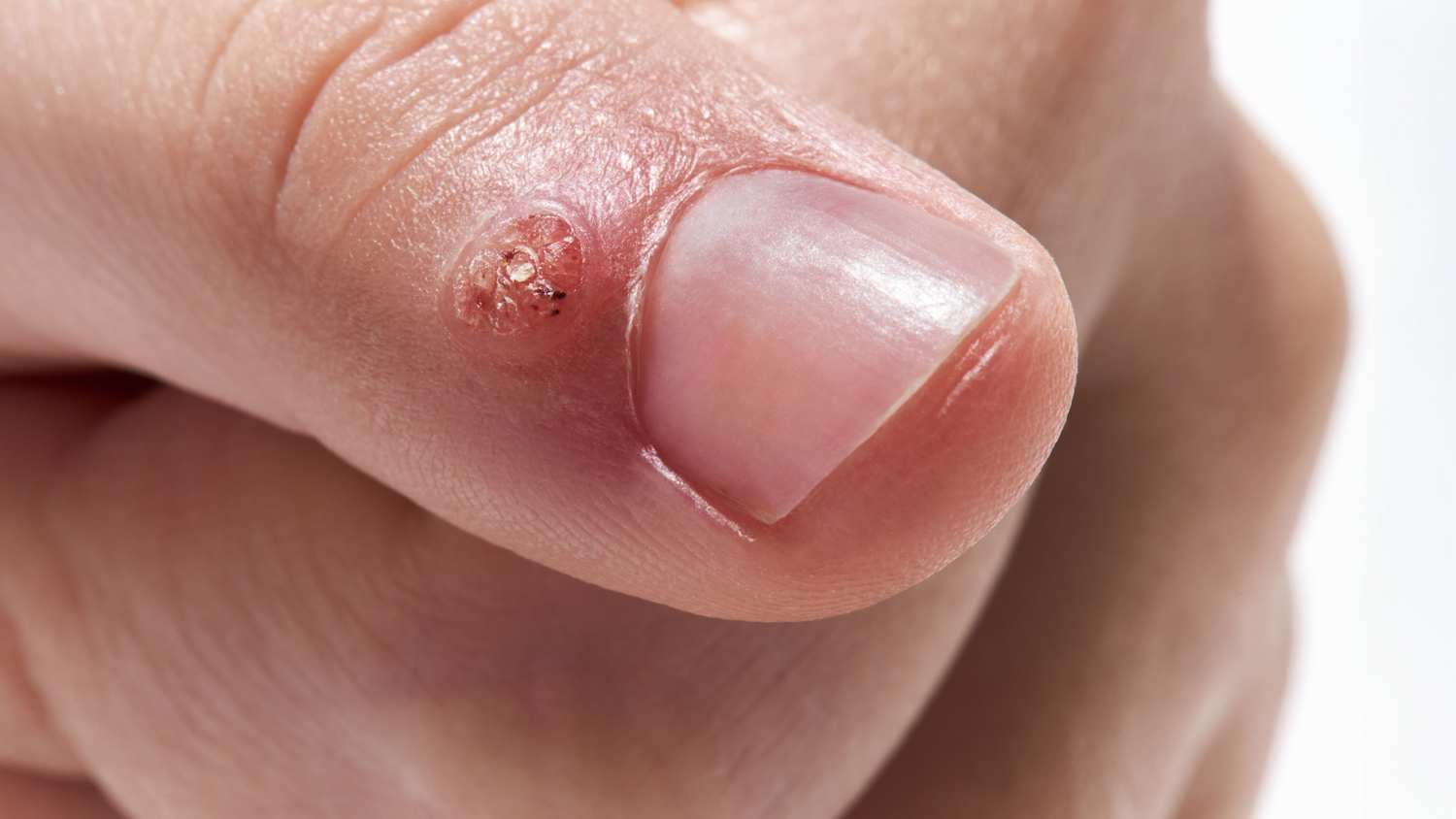 Eine Warze  an einem Finger vorne am Nagelansatz