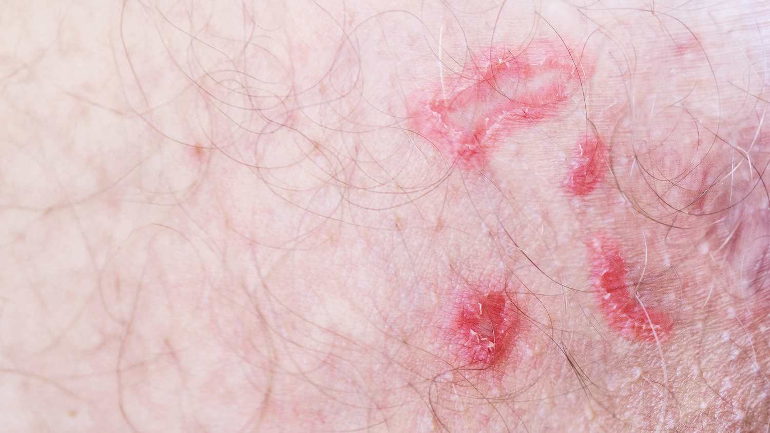 Krätzmilben im Intimbereich eines Mannes
