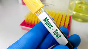 Mpox Test im Labor
