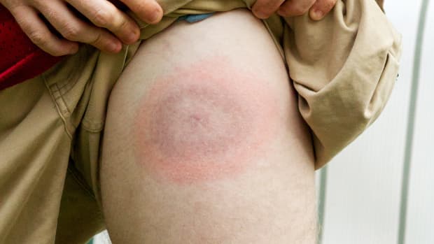 Borrelioseinfektion mit der Wanderröte - ein roter kreisförmiger Fleck am Oberschenkel eines jungen Mannes