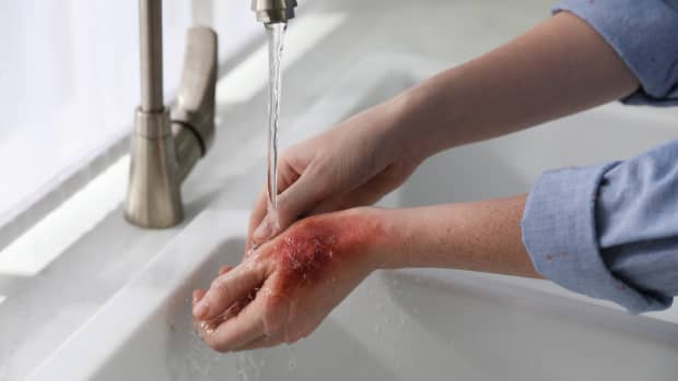 Eine Frau kühlt eine Verbrennung an der Hand unter dem Wasserhahn