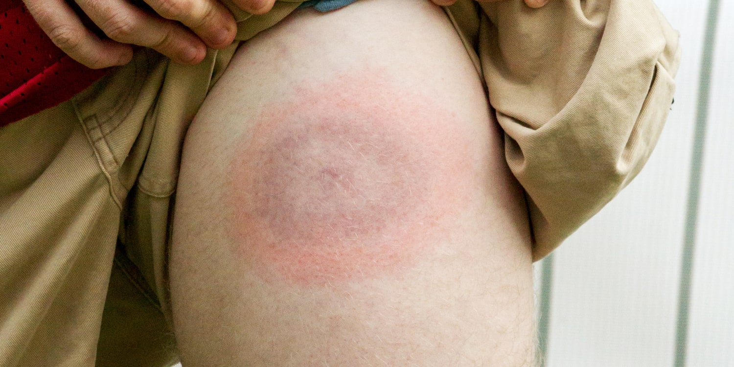 Borreliose Wie Sie erste Symptome erkennen